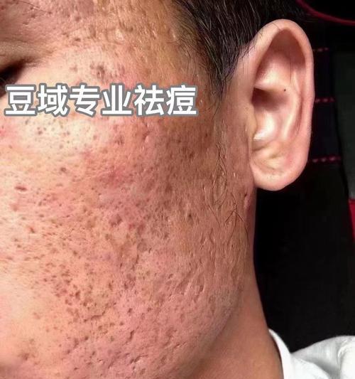 挤痘痘的危害及不可取之处（了解为什么不能挤痘痘，避免后悔终生）
